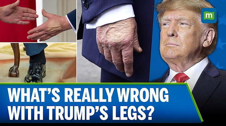 Donald Trump Diagnosed with Chronic Venous Insufficiency | What It Means | Explained | N18G