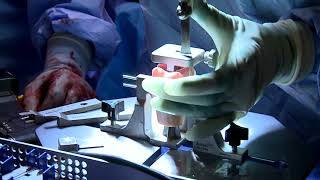 Treatment of Glenoid Bone Loss | Fresh Osteochondral Distal Tibia Allograft Preparation