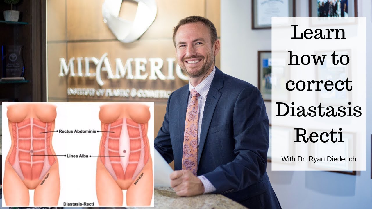 Learn how to correct Diastasis Recti YouTube