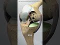 Partial knee replacement surgery #sad #lofi #music #aesthetic