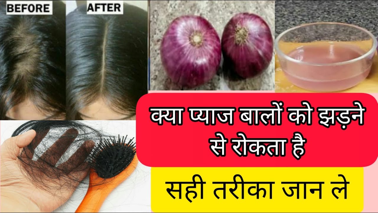 How To Use Onion Juice For Hair Regrowth/Dandruff/Hairfall Control