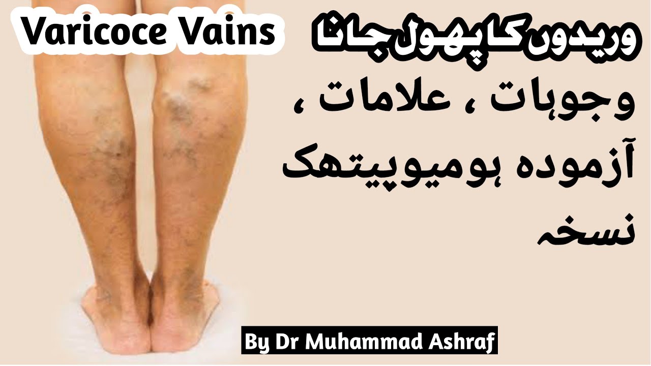 Varicose Veins Homoeopathic Treatment Urdu Hindi 