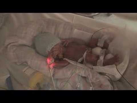 24 week Premature Baby Toby 12 hours old