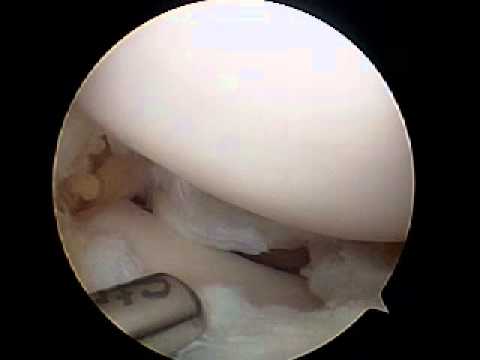 Video: Knie Meniscus Cyste