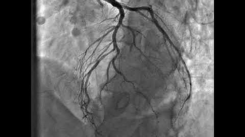 RCA CTO intervention