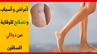 أعراض و أسباب و نصائح للوقاية من دوالي الساقين بطرق طبيعية 100 في 100