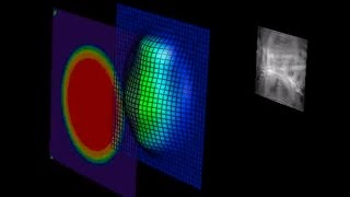 Stanford Hospitals Clinics Laser Vision Correction Wavefront Lasik