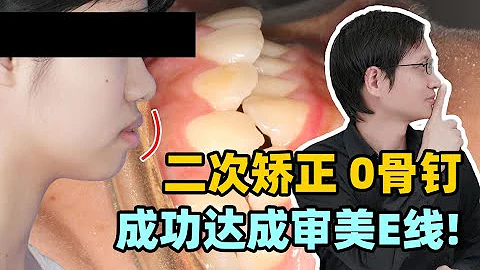 二次矯正0骨釘 ！拯救側顏！成功達成審美E線！ - 天天要聞