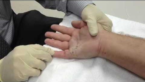 Xiaflex Release for Dupuytren Contractures