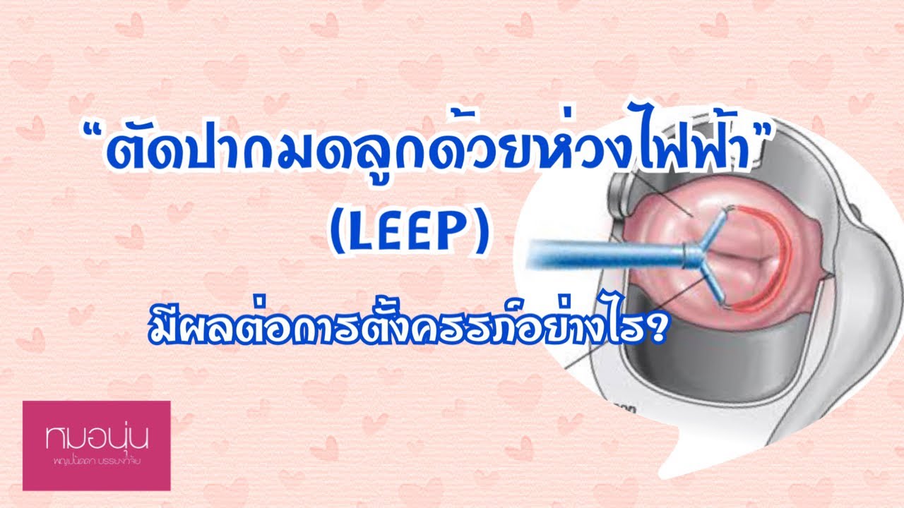 ตัดปากมดลูกด้วยห่วงไฟฟ้า (LEEP)  มีผลต่อการตั้งครรภ์อย่างไร? | อยากท้องต้องรู้ | DrNoon Channel