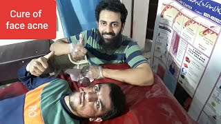 Hijama for face | cupping therapy |acne treatment | pimples treatment |