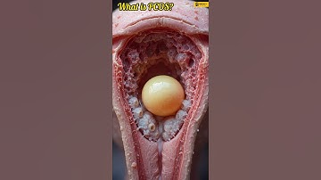 What is PCOS? | How PCOS Affects the Body Explained in 30 Seconds