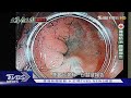 大腸癌 蟬聯癌王15年！兩城市做這事 罹腸癌機率低22%！│大腸癌王國搶救中｜TVBS新聞 健康2.0 @tvbshealth20