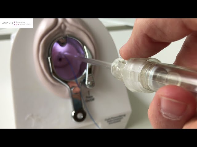 Demo Video of IUD Insertion with ASPIVIX (R&D) class=