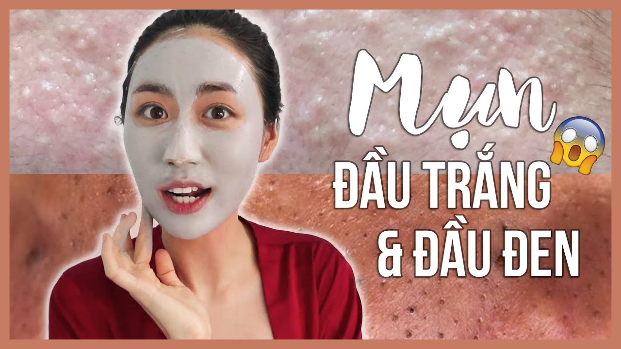 SKINCARE CHO MỤN ĐẦU ĐEN \u0026 TRẮNG!!! THANH LÝ MỤN SERIES