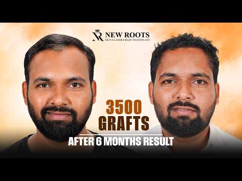 Month by Month… His Hair Transformation Is UNBELIEVABLE! 😱 | Hair Transplant Pune | Cost | Marathi