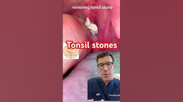 Removing tonsil stones #shorts