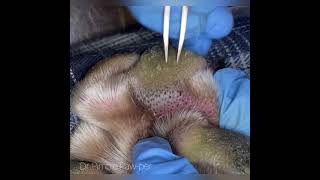 Judah-blocked follicle removal