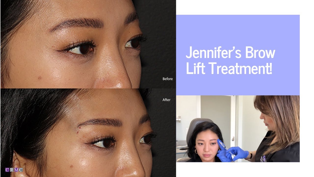 What Is A Thread Brow Lift