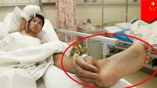 Miracle surgery: Severed hand saved after being attached to man's ankle