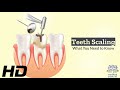 Teeth Scaling: From Tartar Trouble to Pearly Whites