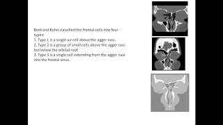 Bent And Kuhn Classsification Of Frontal Cells
