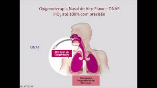 Oxigenoterapia de Alto Fluxo Nasal na Insuficiência Respiratória Aguda Parte 1A: Como funciona?