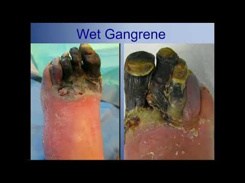 Video: Treatment Of Gangrene Without Amputation