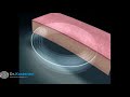 History- femtosecond laser correction of presbyopia- INTRACOR