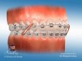 Orthodontic Marketing &amp; Patient Education: Overjet Elastics