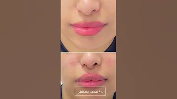 فيلر الشفايف بلمسة بسيطه تزيدك جاذبية 