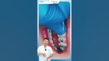 Chun Chuỗi Có Tác Dụng Gì Trong Niềng Răng | Nha Khoa Minh Châu