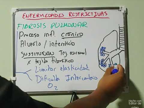 Vídeo: Alveolitis Fibrosante Idiopática: Síntomas, Tratamiento, Formas, Estadios, Diagnóstico