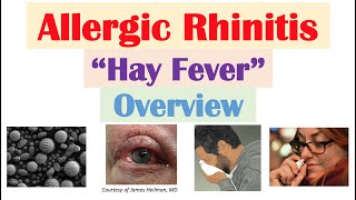 Allergic Rhinitis (Hay Fever): Risk Factors, Pathogenesis, Signs and Symptoms, Diagnosis, Treatment