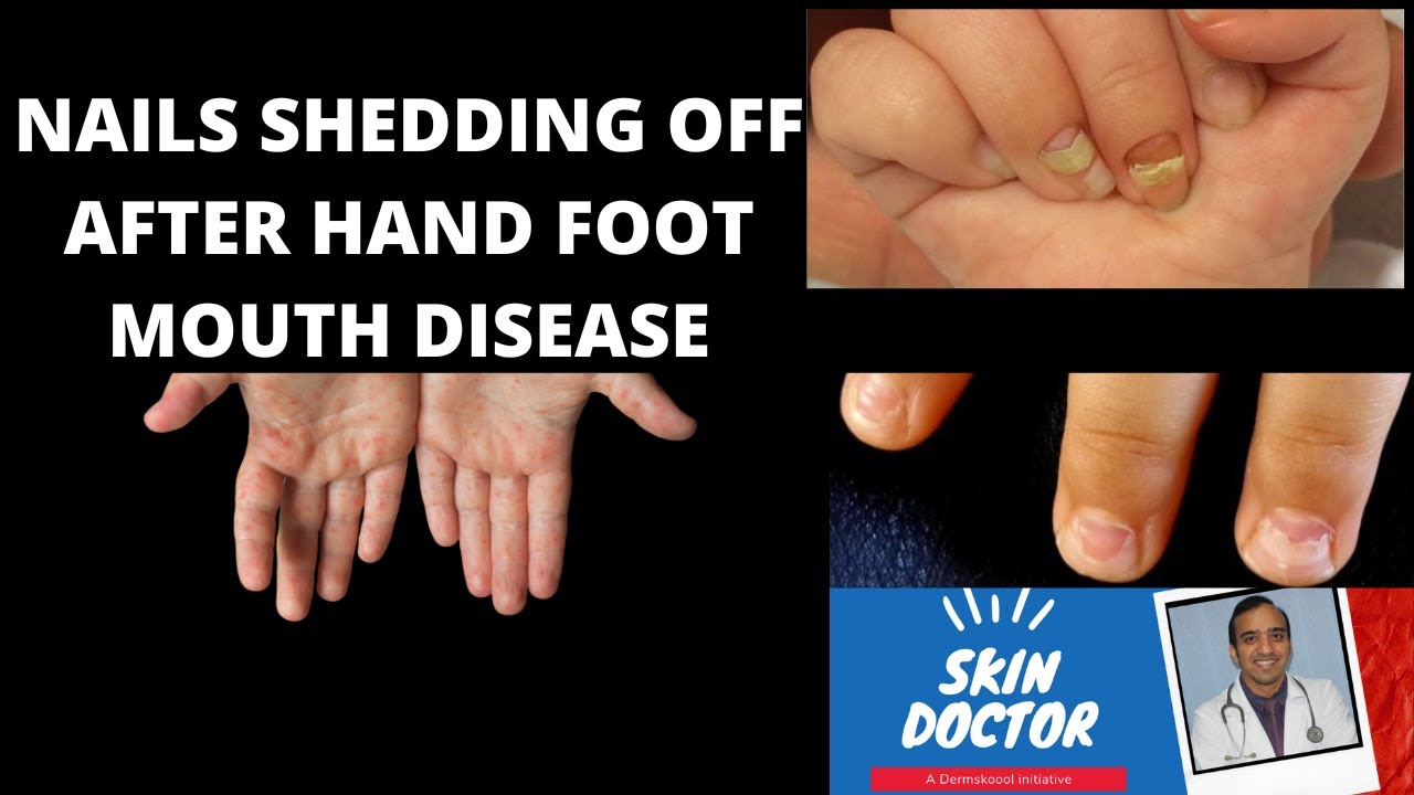 Why Are My Toenails Not Growing? - Vascular Health