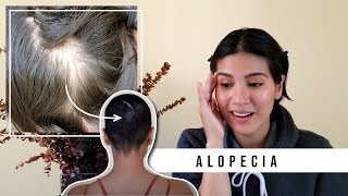 StoryTime: How I grew back my hair after Alopecia | Hair loss.