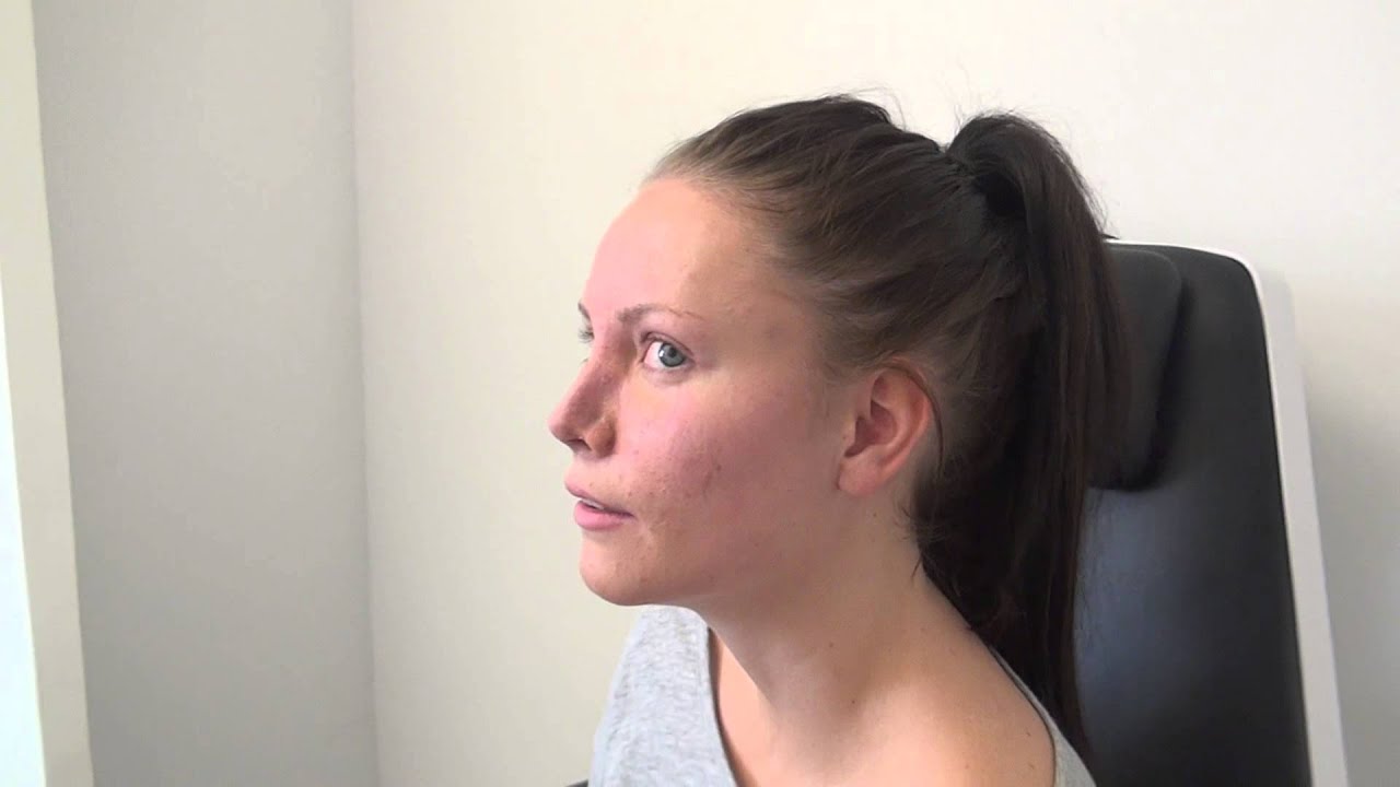 Näsplastik 56 återbesök efter 1 vecka  Primakliniken plastikoperationer