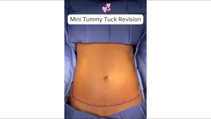 Michelle's Life Changing Tummy Tuck and Mommy Makeover 