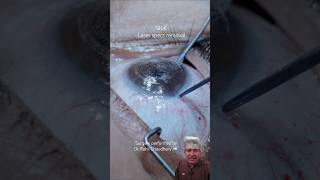 SILK/SMILE Laser for specs removal