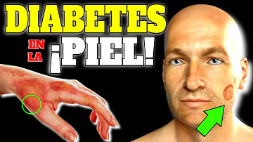 ¿Cómo se manifiesta la diabetes en la piel?