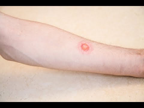 Video: Infeksioni I Ringworm Në Derrat Guinea