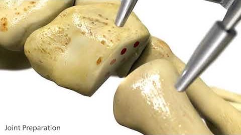 ORTHOLOC™ 2 LapiFuse™ Triplanar Bunion Correction Animation