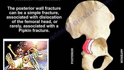 Acetabulum Fracture Posterior Wall Fracture   - Everything You Need To Know - Dr. Nabil Ebraheim