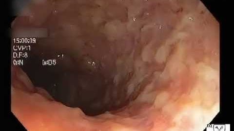 Clostridium Difficile Colitis