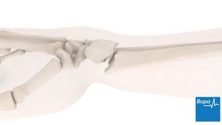 How a wrist fracture is treated