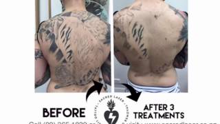 Tattoo Removal Auckland  Beautilase