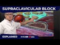 Supraclavicular Block - Regional anesthesia Crash course with Dr. Hadzic