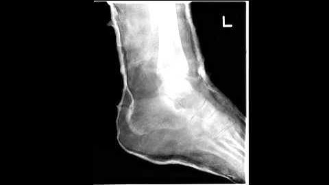 4. Close Contact Casting (CCC): Principles of technique
