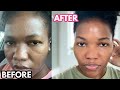 Tretinoin: How I use it For A Flawless Uniform Dark Skin (STOP ACNE)-Dry/Mature/Oily/Sensitive Skin