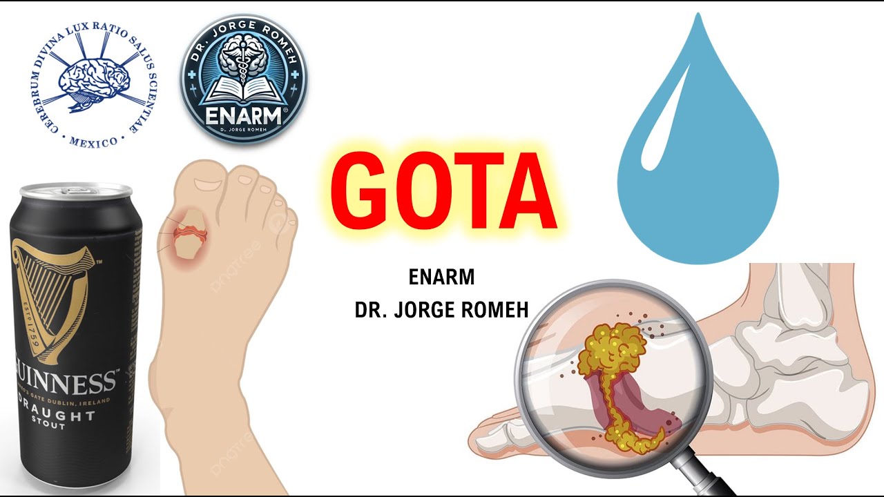GOTA / HIPERURICEMIA - ENARM - TODO LO QUE DEBES SABER